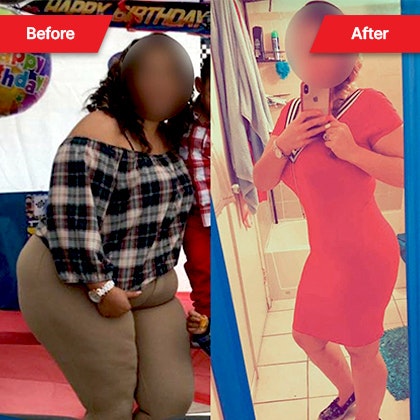 Dr. Ismael Cabrera's patient before and after bariatric surgery