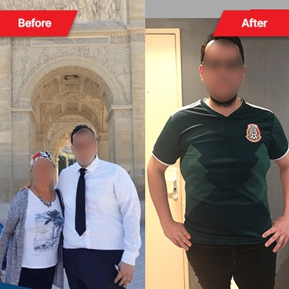 Patient before and after bariatric surgery