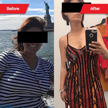 Dr. Cabrera's patient before and after bariatric surgery